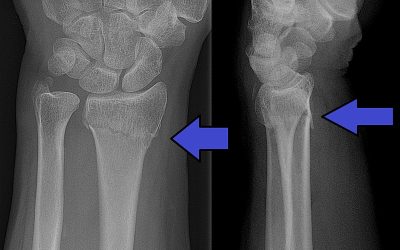 Fractura de Colles: Una lesión común en la muñeca