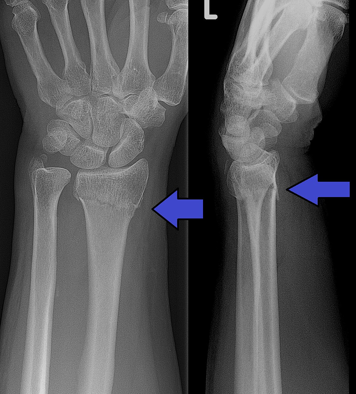 Fractura de Colles: Una lesión común en la muñeca