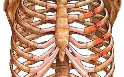Fractura de Costillas: Causas, Síntomas y Tratamiento